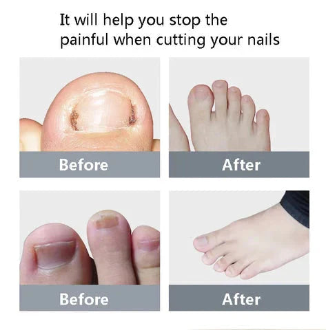 Nail Clipper, Professional Thick & Ingrown Toenail Correction Tool, Pedicure Clippers Toe Nail Cutter for Men & Women, Super Sharp Curved Blade Grooming Tool | Multi |
